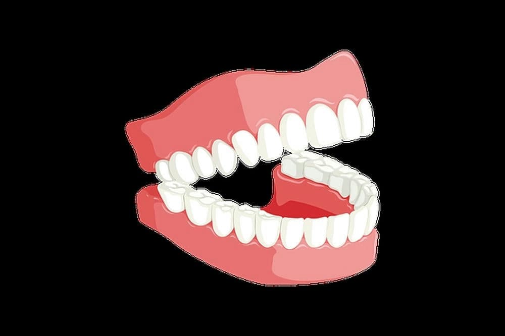 dental implants and dentures