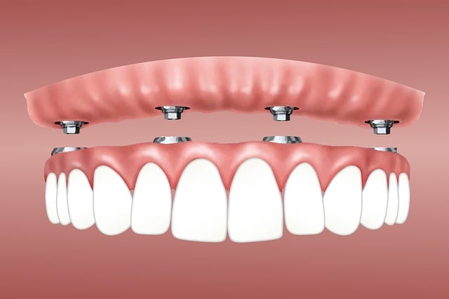 4 on 4 dental implants